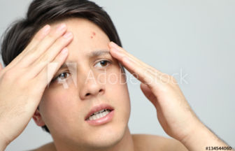 ケミカルピーリング