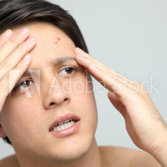 ケミカルピーリング